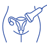Endovaginal